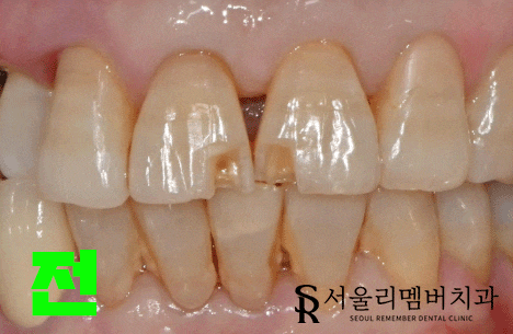 깨진 앞니를 어떤 방법으로 개선하는 게 좋을까? 서울대입구역 리멤버 치과 관련 이미지 3