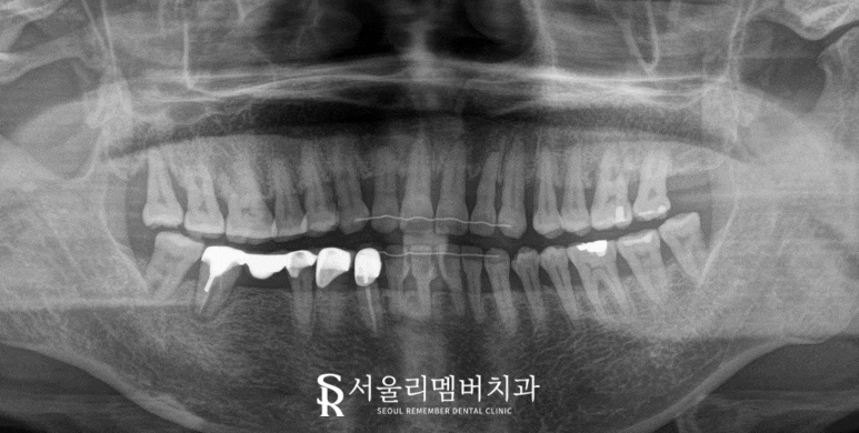 오래된 브릿지와 크라운 보철 임플란트 교체 및 사랑니 발치까지 신대방 치과 관련 이미지 3