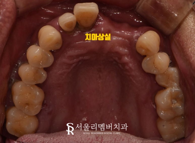 치석이 발치로 이어질 수 있다는 말, 사실일까요?! 봉천동 서울 리멤버 치과 관련 이미지 1