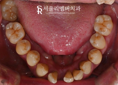 치아 빠지고 흔들리는 어금니와 치주 질환으로 통증 생긴 구강, 관악구 치과 상악 전체 임플란트 및 하악 신경치료 크라운 진행 과정 관련 이미지 4