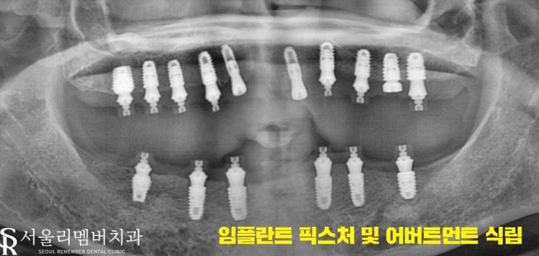 텅텅 여기저기 빠져버린 치아들, 이젠 음식을 씹을 수도 없어요.. 어떡하죠? 서울대입구역 리멤버 치과 관련 이미지 5