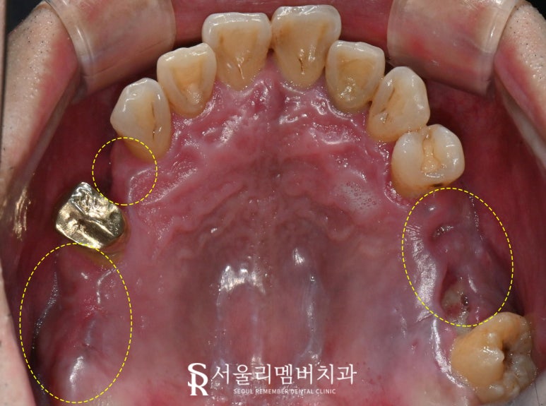 서울대입구역 치과 발치 즉시 다수 네비게이션 임플란트 식립 결과는? 관련 이미지 1