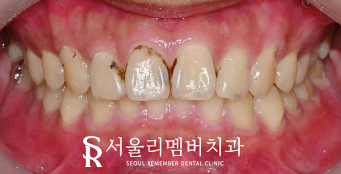 앞니 충치, 서울대입구역 치과 에서 당일 레진 치료로 빠르게 환한 웃음 되찾으세요! 관련 이미지 1