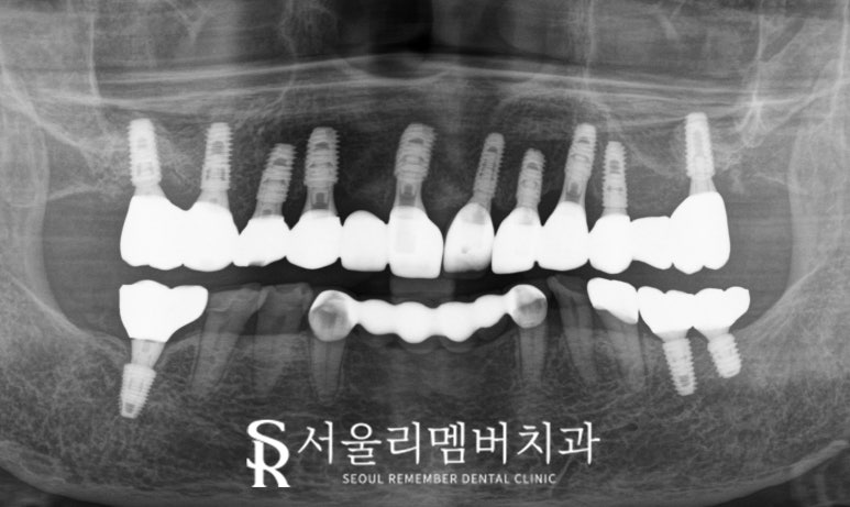 잇몸뼈 소실 다수의 치아 서울대입구역 치과 에서 전체 임플란트 브릿지 수술 진행 관련 이미지 4