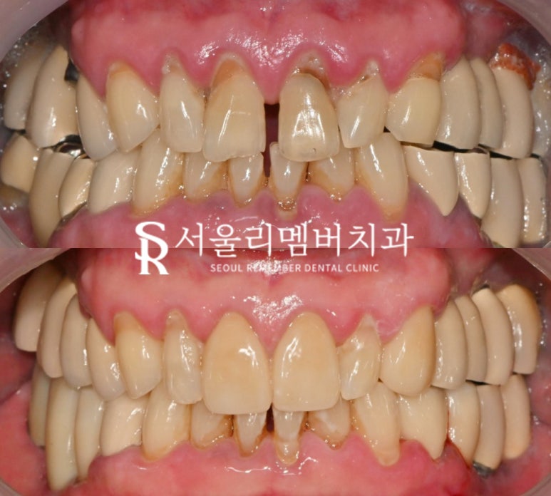 임플란트 및 크라운 으로 구강 환경 개선하는 방법 - 서울대입구역 치과 관련 이미지 9