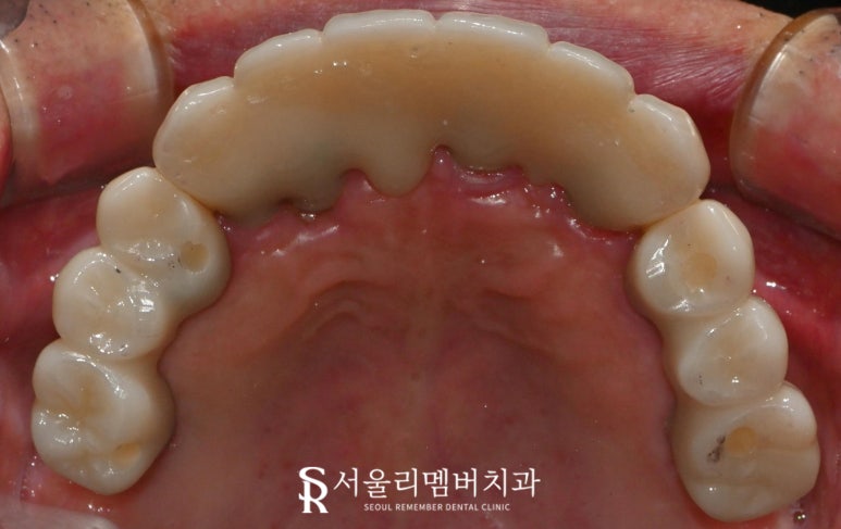 서울대입구역 치과 대표원장이 직접 봐드리는 무치악 환자 전체 임플란트 치료 케이스 관련 이미지 5
