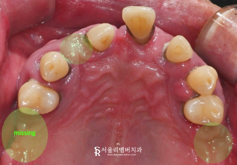 상도동 치과 위아래 다수의 치아 상실, 원가이드를 이용한 디지털 임플란트 로 상하악 전체 재건 가능 관련 이미지 2