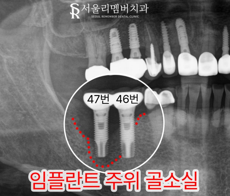 사당역 치과 임플란트 주위 염증으로 픽스처 제거 후 다시 식립 재수술 필요하다면? 관련 이미지 3