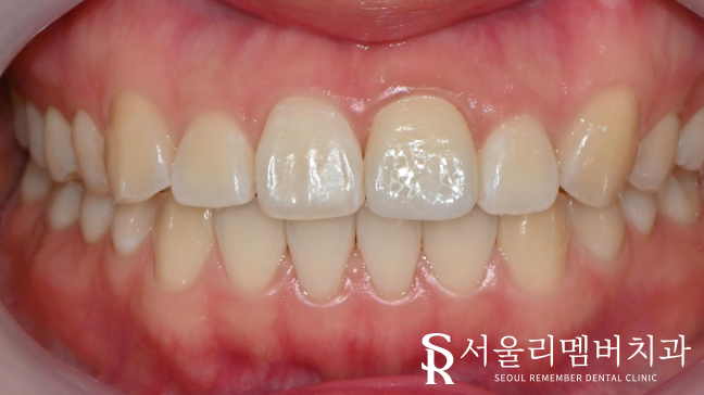 신길동 치과 부러진 앞니, 신경치료로 티 안 나게 개선 완료! 관련 이미지 7