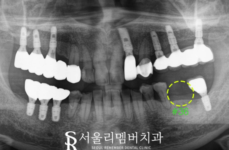 임플란트 잘하는 서울대입구역 치과 , 수면치료로 편안한 진료과정 관련 이미지 2
