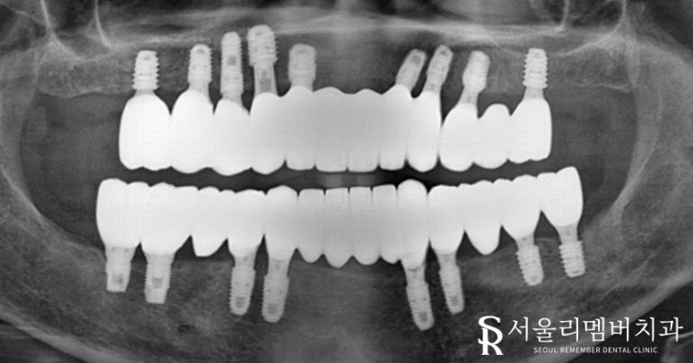 빠져버린 치아 그대로 내버려 두면 안모변형을 초래할 수 있습니다! 신림역 서울 리멤버 치과 관련 이미지 9