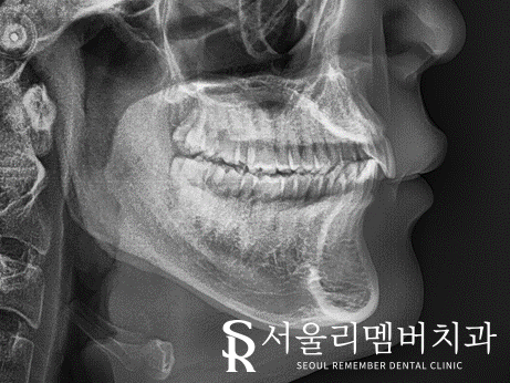 과개교합, 외적인 문제는 물론이며 기능 회복까지 개선하는 것이 중요합니다. 신대방치과 치아교정 관련 이미지 1