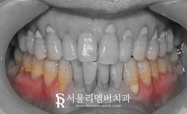 치경부 마모증, 상도동 치과 에서는 어떻게 치료할까? 관련 이미지 2