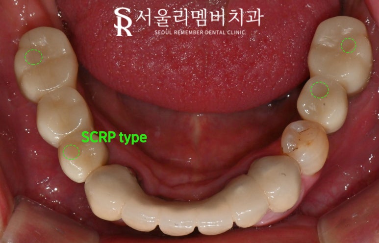 과잉진료 없는 보라매 치과 에서 최소 개수 전악 임플란트 식립 관련 이미지 8