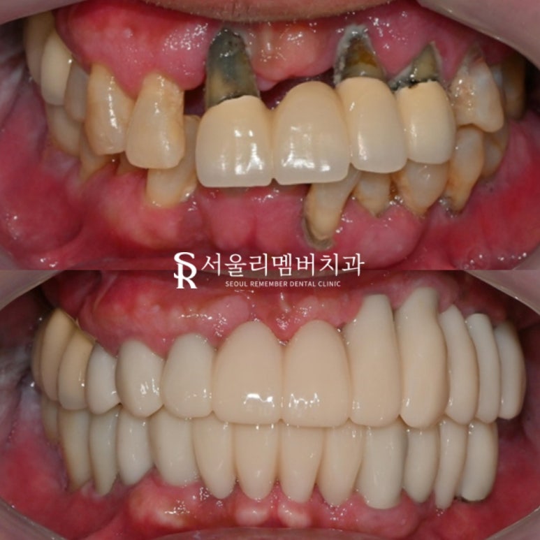 고난도 수술, 서울대입구역 임플란트 치과 에서 치료해야 되는 이유는? 관련 이미지 1