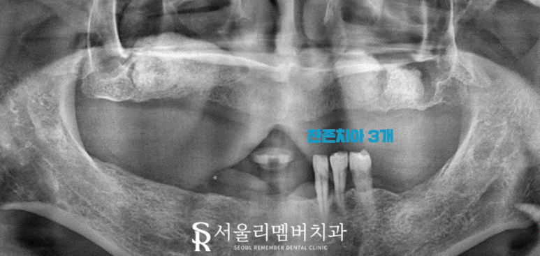 서울대입구역 치과 무너진 수직 고경 어떻게 개선했을까? 관련 이미지 5