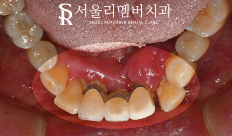 Loose Lower Front Teeth, Sillim Station Dental Clinic, Insurance Anssurge Implant for Patients 65 and Older, Minimal Placement, Lower Cost, Faster Completion image 3