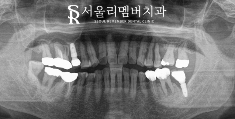 잇몸뼈 녹아버린 치아, 발치 후 그다음은? 사당역 치과 임플란트 관련 이미지 4
