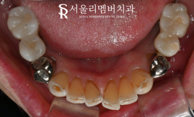 올바른 교합의 중요성, 서울대입구역치과 전체 임플란트 기간 및 과정 관련 이미지 7