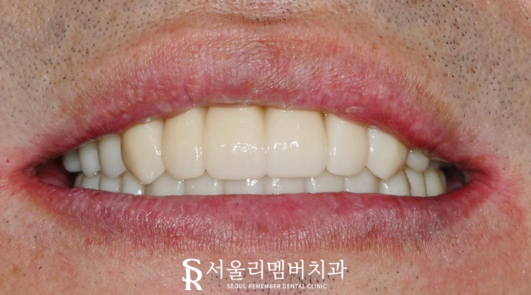 상도동 치과 위아래 다수의 치아 상실, 원가이드를 이용한 디지털 임플란트 로 상하악 전체 재건 가능 관련 이미지 6