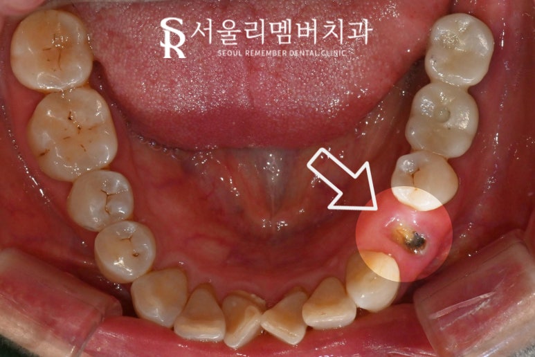 보라매 치과 신경치료 치아 부러짐, 당일 발치 즉시 임플란트 동시 식립(Simple case) 관련 이미지 2