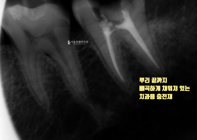 서울대입구역 치과 근관치료 증례 관련 이미지 4