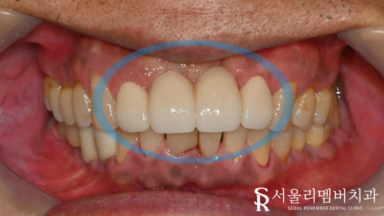 서울대입구역치과 부러진 앞니, 자연치처럼 회복시킬 수 있는 심미보철 치료 과정 관련 이미지 2