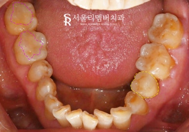 서울대입구역 치과 임플란트, 신경치료 크라운, 인레이 모두 해야 된다면 어떤 진료부터 시작해야 될까요? 관련 이미지 7