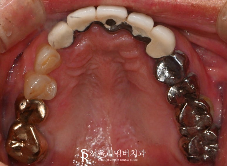 서울대입구역 치과 임플란트, 신경치료 크라운, 인레이 모두 해야 된다면 어떤 진료부터 시작해야 될까요? 관련 이미지 3