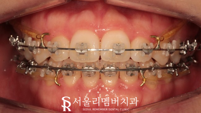 서울대입구역 치과 툭 튀어나온 돌출 때문에 발치교정 진행 관련 이미지 5