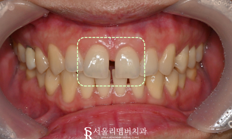 중요한 일 앞두고 앞니가 벌어졌어요. 신대방 치과 에서 레진으로 티 안나게 성형(feat. 다이아스테마) 관련 이미지 1