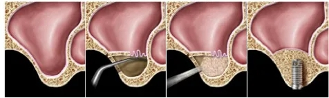 상악동 거상술, 어떤 경우에 필요한 걸까? 서울중앙동 리멤버 치과 관련 이미지 6