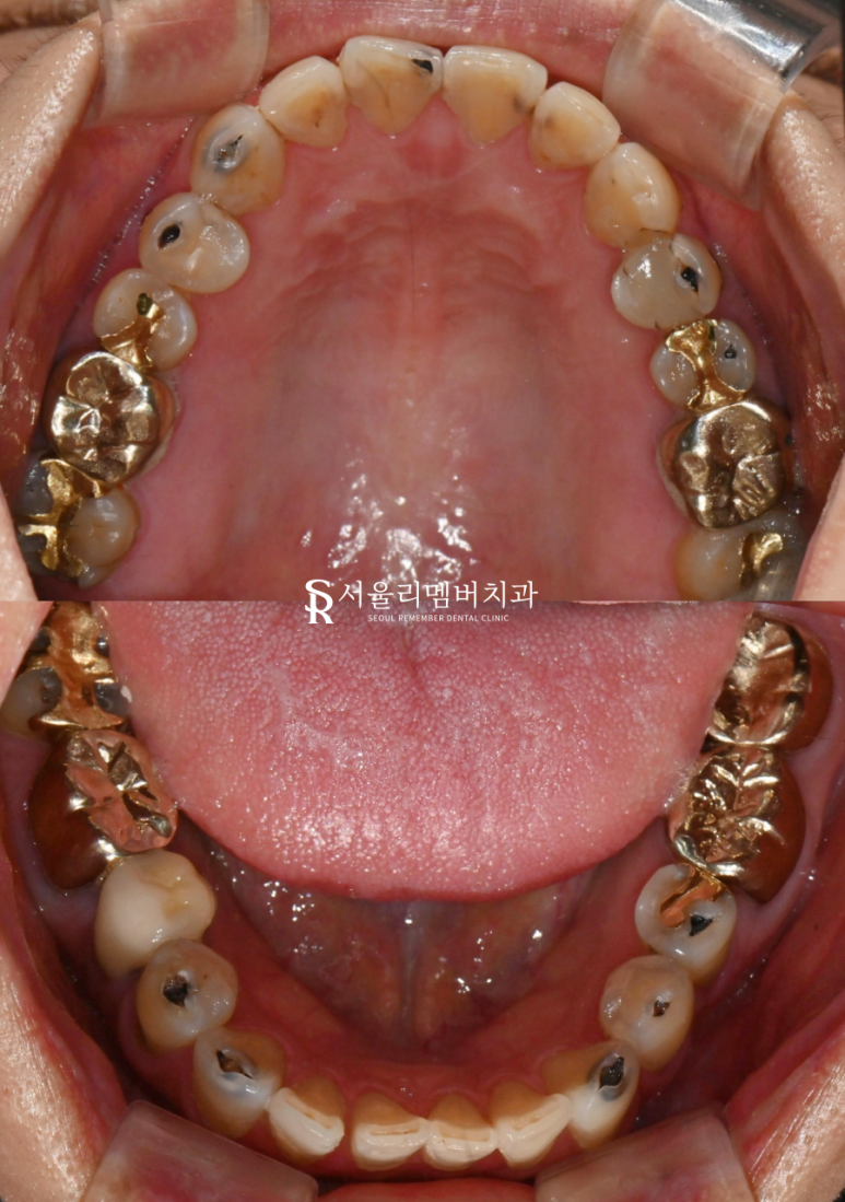 곳곳에 많은 충치, 신림역 치과 에서 앞니 심미 레진 치료와 어금니 지르코니아 크라운 치료 관련 이미지 2
