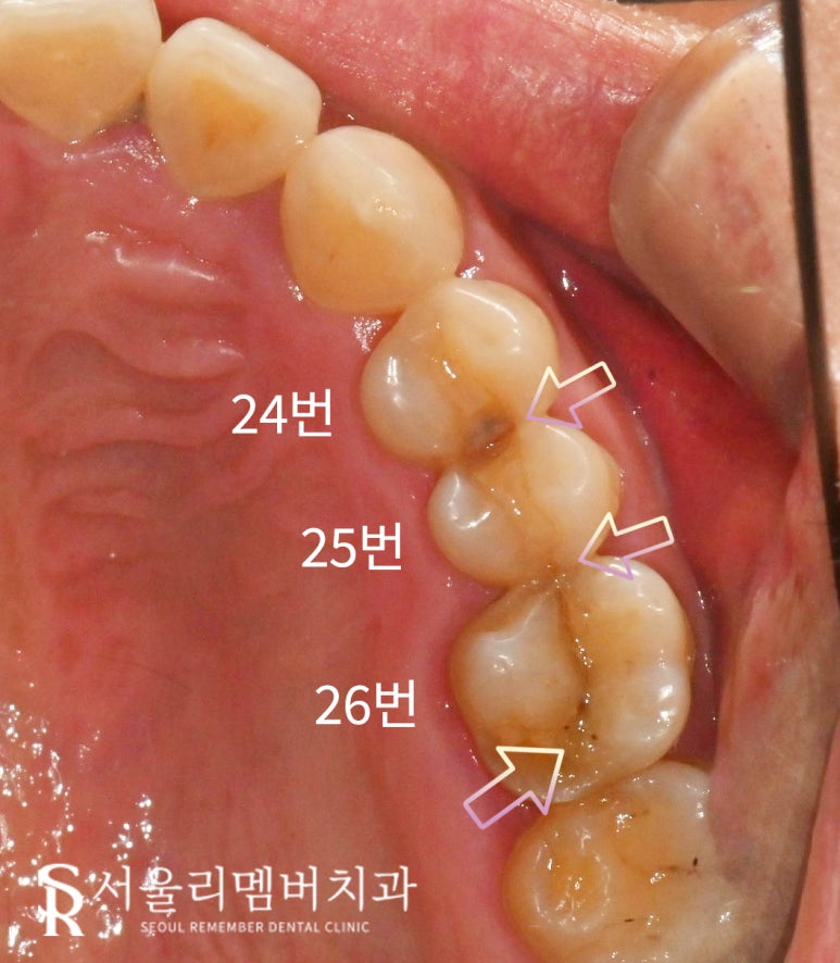 서울대입구 치과 치아 파절로 인한 신경치료 크라운 및 씹을때 통증으로 발치 후 임플란트 관련 이미지 2