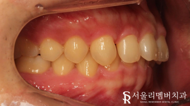 상도동치과 에서 발치 없이 깊게 물리는 과개교합 및 2급 부정교합 개선! 관련 이미지 2