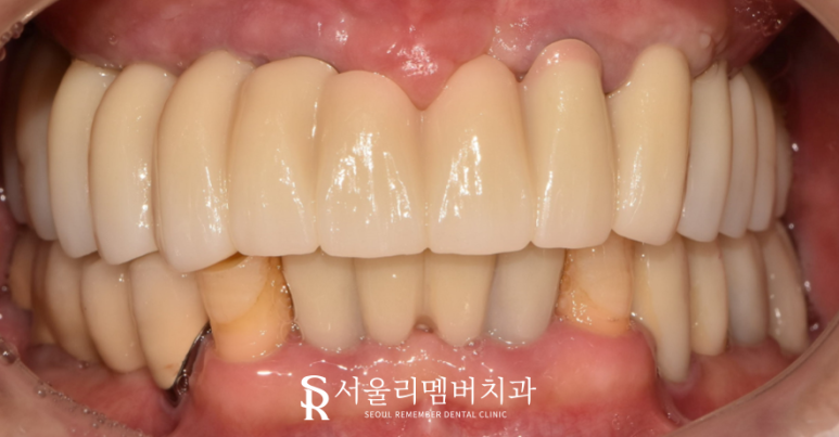 전에 씌워놨던 크라운에서 통증이 느껴져요.. 도대체 왜 그런 거죠? 서울대입구역 서울 리멤버 치과 관련 이미지 6