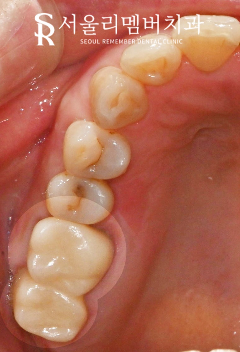 봉천역 치과 어금니 보철 후 음식물 끼임 및 치아 파절, 신경치료 크라운 및 임플란트 관련 이미지 6