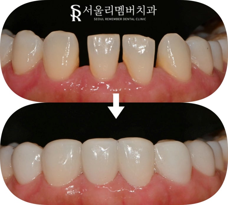 낙성대 치과 앞니 틀어짐 하악 전치 측절치 결손 라미네이트로 공간 닫기 성공 관련 이미지 10