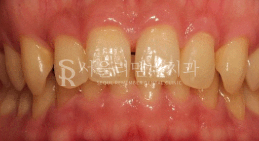 상도동치과 에서 발치 없이 깊게 물리는 과개교합 및 2급 부정교합 개선! 관련 이미지 11