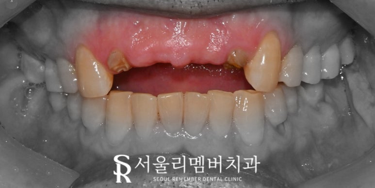 서울대입구역 치과 오래된 브릿지 부러진 앞니 발치 후 네비게이션 임플란트 식립 사례 관련 이미지 1