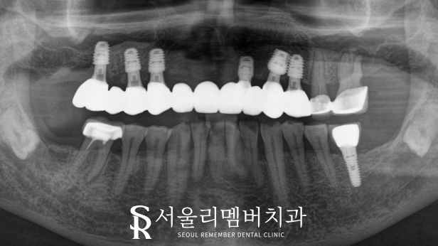 오래된 전체 브릿지 방치하면 이런 문제를 일으킬 수 있습니다. 서울대입구역 치과 풀케이스 치료 과정 관련 이미지 4