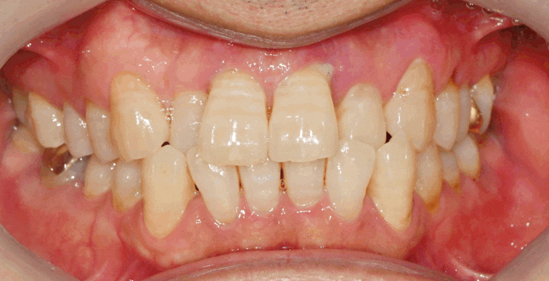보라매 치과 삐뚤어진 교합 불량 앞니, 임플란트로 가지런하게 만들어드린 사례 관련 이미지 1