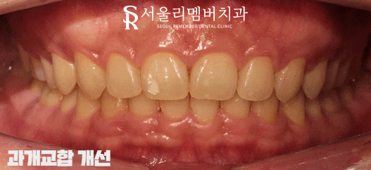 상도동치과 에서 발치 없이 깊게 물리는 과개교합 및 2급 부정교합 개선! 관련 이미지 7