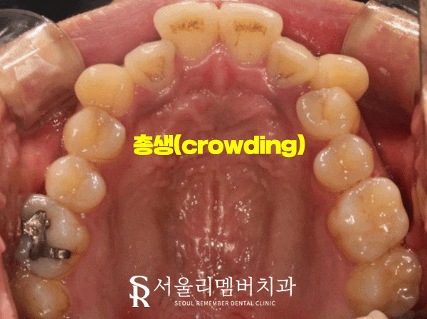 서울대입구역 치과 에서 들쑥날쑥 했던 치열, 비발치로 개선해 드렸습니다. 관련 이미지 2