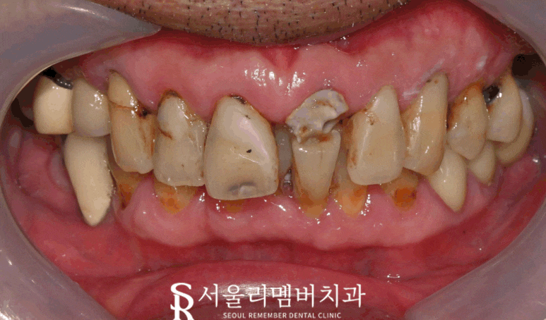 신대방 치과, 깨지고 충치가 심한 앞니 심미 크라운 수복한 증례 관련 이미지 5