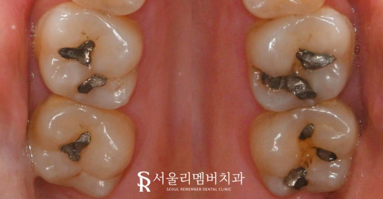오래된 아말감 신림 치과 수면(의식하 진정) 마취 후 스트라우만 나이스 인레이로 교체 (좌우 2회로 나누어 진행 가능) 관련 이미지 4