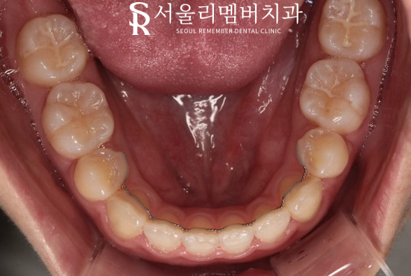 서울대입구역 치과 툭 튀어나온 돌출 때문에 발치교정 진행 관련 이미지 10
