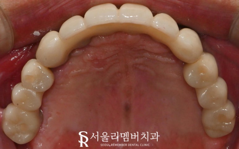 신대방 치과 고난도 전악 임플란트 수술 가능 관련 이미지 7