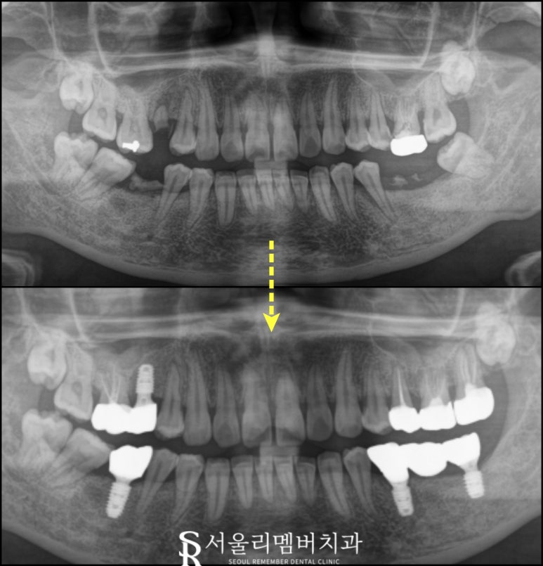 "구강에 빈 곳이 있으면 다른 치아가 우왕좌왕" 서울대입구역 치과 임플란트 수술 후기 관련 이미지 3