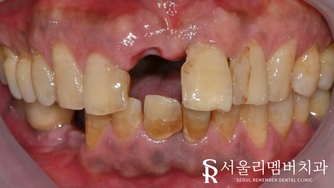 서울대입구역치과 부러진 앞니, 자연치처럼 회복시킬 수 있는 심미보철 치료 과정 관련 이미지 1